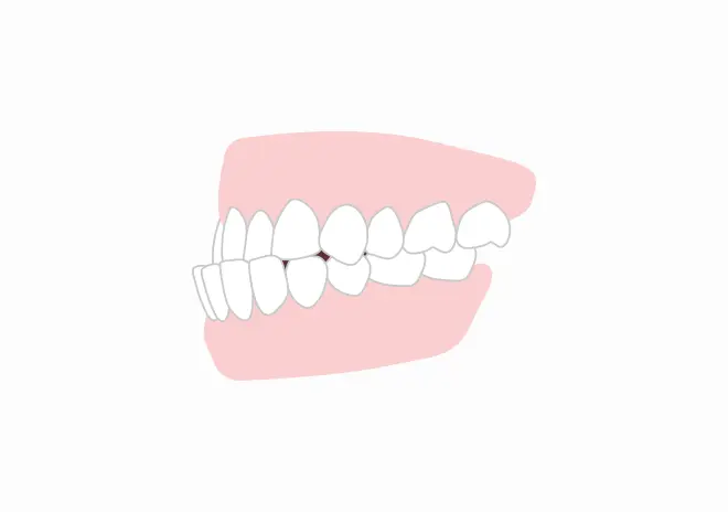 受け口（下顎前突・反対咬合）