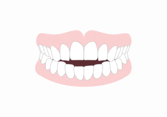 前歯がかみ合わない（開咬）